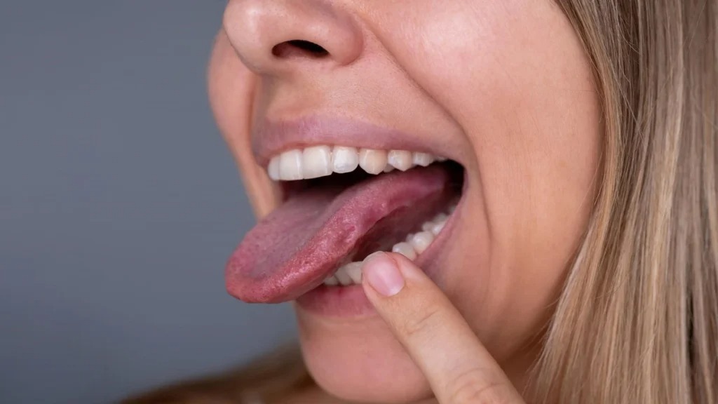 Gjuhë me gjurmë anash? Mund të tregojë probleme me vitaminat, tiroiden ose gjumin